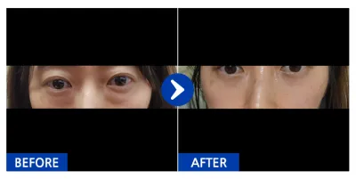 [Ганнам Унни] Нүдний доорх өөх шилжүүлэн байршуулах, хацрын өөх шилжүүлэн суулгаснаас хойш 1 сар / Хэрэглэгчийн нэр: 라라라랑인