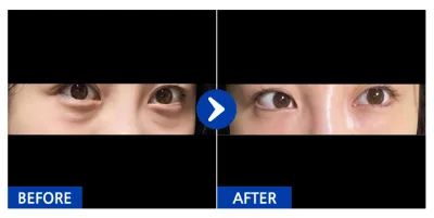 [Ганнам Унни] Нүдний доорх өөх шилжүүлэн байршуулаад 7 хоног / Хэрэглэгчийн нэр: 동지금지