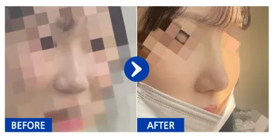 [Ганнам Унни] Хамарны мэс засал хийлгээд 1 сар / Хэрэглэгчийн нэр: luckyyeji