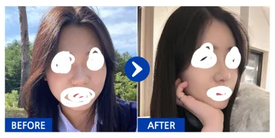 [Ганнам Унни] Хамарны мэс засал, өөх шилжүүлэн суулгаснаас хойш 1 сар / Хэрэглэгчийн нэр: sunbini