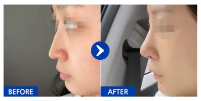 [Ганнам Унни] Хамарны мэс засал хийлгээд 1 долоо хоног / Хэрэглэгчийн нэр: 쀵삥