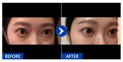 [Ганнам Унни] Нүдний доорх өөх шилжүүлэн байршуулаад 1 сар_liina_