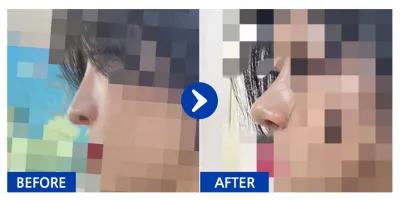 [Ганнам Унни] Хамарны мэс засал хийлгээд 1 сар_aaaa1212