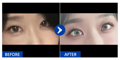 [Ганнам Унни] Нүдний доорх өөх шилжүүлэн байршуулах / 1 сарын дараа / Хэрэглэгчийн нэр: hyupp