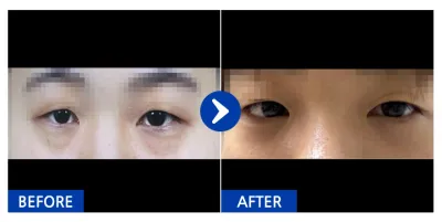 [Ганнам Унни] Нүдний доорх өөх шилжүүлэн байршуулах / 1 сарын дараа / Хэрэглэгчийн нэр: yykkyyk