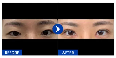 [Ганнам Унни] Давхраа, нүдний дотор булан нээх, нүдний хэлбэр засах / 1 сарын дараа / Хэрэглэгчийн нэр: 으비라아레벱