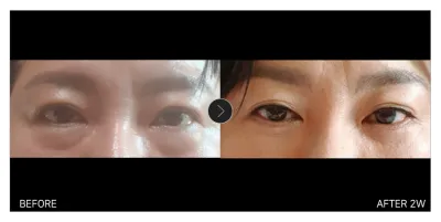 [Gangnam Unni сэтгэгдэл] Доод зовхи + Утас татуулах мэс засал 2 дахь долоо хоног / Никнэйм: 가니시니