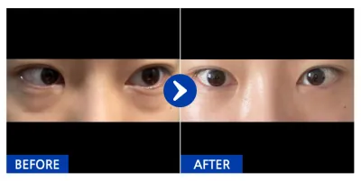 [Ганнам Унни] Нүдний доорх өөх шилжүүлэн байршуулах / 1 сарын дараа / Хэрэглэгчийн нэр: castle030