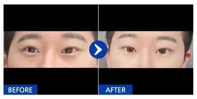 [Ганнам Унни] Нүдний доорх өөх шилжүүлэн байршуулах / 1 сарын дараа / Хэрэглэгчийн нэр: 쟝쟝59