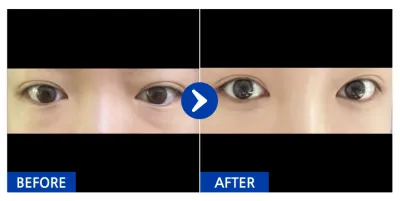 [Ганнам Унни] Нүдний доорх өөх шилжүүлэн байршуулах / 1 сарын дараа / Хэрэглэгчийн нэр: 하잇어