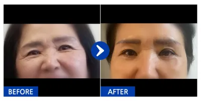 [Ганнам Унни] Хөмсөг өргөх мэс засал, доод зовхины мэс засал / 1 сарын дараа / Хэрэглэгчийн нэр: 잠실자네