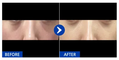 [Ганнам Унни] Нүдний доорх өөх шилжүүлэн байршуулах / 1 сарын дараа / Хэрэглэгчийн нэр: 라면김밥떡볶이