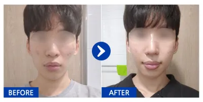 [Ганнам Унни] Дөрвөлжин эрүү, шанаа, хамар / 1 сарын дараа / Хэрэглэгчийн нэр: chgv