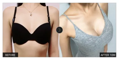 [Gangnam Unni сэтгэгдэл] Хөхний гоо сайхны мэс засал 10 дахь сар / Никнэйм: 그마아아안