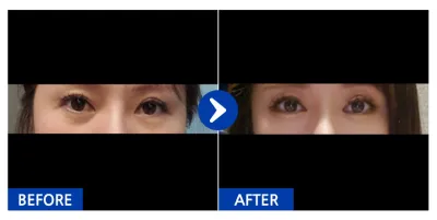 [Ганнам Унни] Нүдний доор өөх шилжүүлэн суулгах / 3 долоо хоногийн дараа / Хэрэглэгчийн нэр: 흘러가는데로~