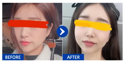 [Бабиток] Нүүрний бүх хэсэгт өөх шилжүүлэн суулгах / 1 сарын дараа / Хэрэглэгчийн нэр: 주유би