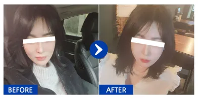 [Бабиток] Нүүрний бүх хэсэгт өөх шилжүүлэн суулгах, утас татуулах / 2 долоо хоногийн дараа / Хэрэглэгчийн нэр: 갱쥐zXzo