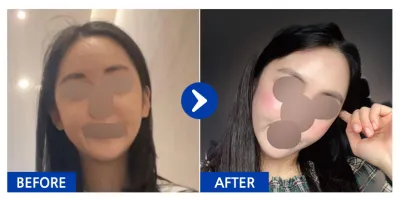 [Ганнам Унни] Нүүрний бүх хэсэгт өөх шилжүүлэн суулгах / 1 сарын дараа / Хэрэглэгчийн нэр: 예뻐지쟈아아