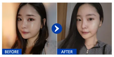 [Gangnam Unni] Нүүрний өөх соруулах / 1 дэх сар / Ник нэр: Гамжаможин