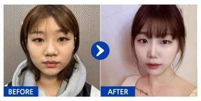 [Gangnam Unni сэтгэгдэл] Хамрын мэс засал / 3 дахь сар / Ник нэр: Уннаннан