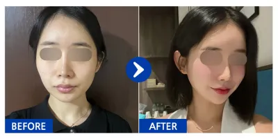 [Gangnam Unni сэтгэгдэл] Нүүрний хэлбэр засах 3 төрөл (Хацар, эрүүний үзүүр, дөрвөлжин эрүү), Хөх (Ментор смүүс) / 3 дахь сар / Ник нэр: Крүрүрүппингппон