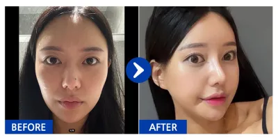 [Gangnam Unni сэтгэгдэл] Нүүрний хэлбэр засах 3 төрлийн хагалгаа (шанаа, эрүүний үзүүр, дөрвөлжин эрүү), хамар засах хагалгаа / 3 дахь долоо хоног / Ник нэр: 박땐땐