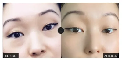 [Gangnam Unni сэтгэгдэл] Нүдний доод өөх шилжүүлэн байрлуулах 3 дахь сар / Никнэйм: 개구리왕눈