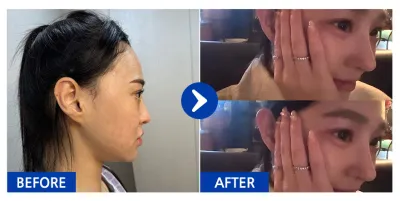 [Gangnam Unni сэтгэгдэл] Хамрын дахин хагалгаа / 3 дахь долоо хоног / Ник нэр: 하이루익바