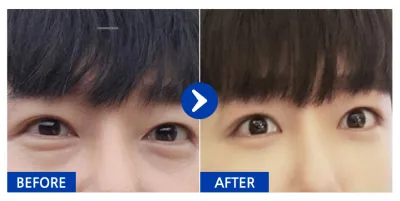 [Gangnam Unni] Нүдний доорх өөх шилжүүлэн байрлуулах 1 сар / Ник нэр: 크리스으