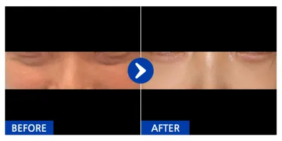 [Gangnam Unni] Нүдний доорх өөх шилжүүлэн байрлуулах 1 сар / Ник нэр: 미ㅣ미미미ㅣ