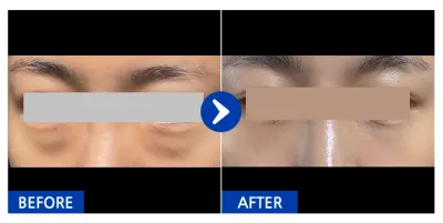 [Gangnam Unni] Нүдний доорх өөх шилжүүлэн байрлуулах / 1 сар / Ник нэр: 뿌엥에우