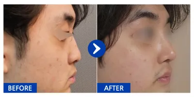 [Gangnam Unni] Хамар засах хагалгаа / 1 сар / Ник нэр: 건망고애호가