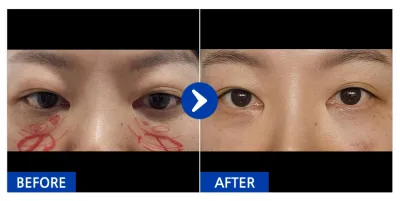 [Gangnam Unni] Нүдний доорх өөх шилжүүлэн байрлуулах / 1 сар / Ник нэр: 유리알76