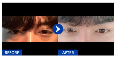 [Gangnam Unni] Нүдний доод өөх шилжүүлэн суулгах / 1 сар / Хэрэглэгчийн нэр: Ким Дун Үн