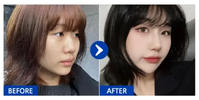 [Babytalk сэтгэгдэл] Хамарны мэс засал / 1 долоо хоног / Хэрэглэгчийн нэр: Нананананананни