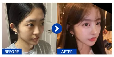 [Gangnam Unni сэтгэгдэл] Хамарны мэс засал, духны өөх шилжүүлэн суулгах / 1 долоо хоног / Хэрэглэгчийн нэр: Нянняннян-үн-үн