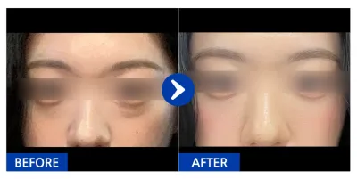 [Gangnam Unni] Нүдний доод өөх шилжүүлэн суулгах / 1 сар / Хэрэглэгчийн нэр: Минминхан-кюль