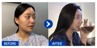 [Babytalk] Хамарны мэс засал, нүүрний хэлбэр засах 3 төрөл (шанаа, эрүүний өнцөг, эрүүний үзүүр) / 3 сар / Хэрэглэгчийн нэр: Пак Тэн Тэн