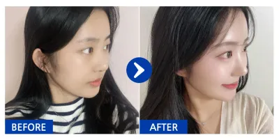 [Babytalk] Хамарны мэс засал, духны өөх шилжүүлэн суулгах / 2 долоо хоног / Хэрэглэгчийн нэр: Нянняннян-үн-үн