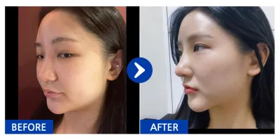 [Babytalk] Хамрын мэс засал / 2 дахь долоо хоног / Никнэйм : Иппуиппю2