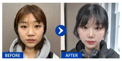 [Babytalk] Хамрын мэс засал / 1 дэх сар / Никнэйм : Нананананананни