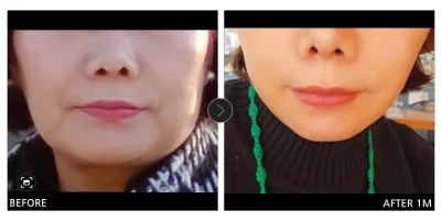 [Gangnam Unni сэтгэгдэл] Мини нүүр өргөлт / 1 сар болж байна / Никнейм: Смайл (Мин Гён)