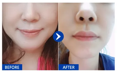 [Gangnam Unni сэтгэгдэл] Мини нүүр өргөлт / 1 сар болж байна / Никнейм: Хондэманё