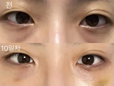 [Gangnam Unni] Нүдний доорх өөх шилжүүлэн байршуулах / 10 дахь өдөр / Хэрэглэгчийн нэр: suntree