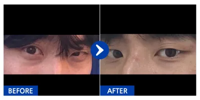 [Gangnam Unni] Нүдний доорх өөх шилжүүлэн байршуулах / 3 дахь сар / Хэрэглэгчийн нэр: 신방백선생