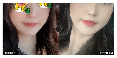 [Gangnam Unni сэтгэгдэл] Нүүрний хэлбэр засах хагалгаа 2 сар болж байна / Ник нэр: yrBang