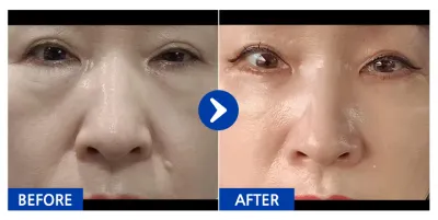 [Gangnam Unni] Доод зовхины хагалгаа + Өөх шилжүүлэн суулгах / 1 дэх сар / Хэрэглэгчийн нэр: 산수향