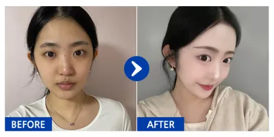 [Gangnam Unni] Хамар засах хагал