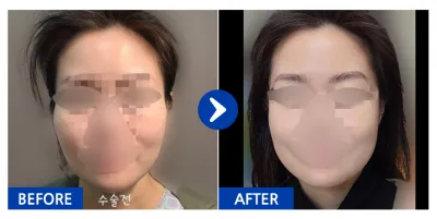 [Babytalk] Нүүрний хэлбэр засах 2 төрөл (Шанаа, Дөрвөлжин эрүү) / 1 сар болж байна / Никнейм: Токки65Nsj