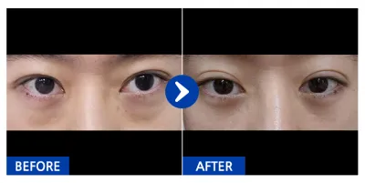 [Babytalk] Нүдний доод өөх шилжүүлэн байрлуулах / 1 сар болж байна / Никнейм: Нян-иKdOcl